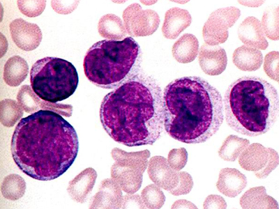 中科院研发白血病新药抑制率达65%