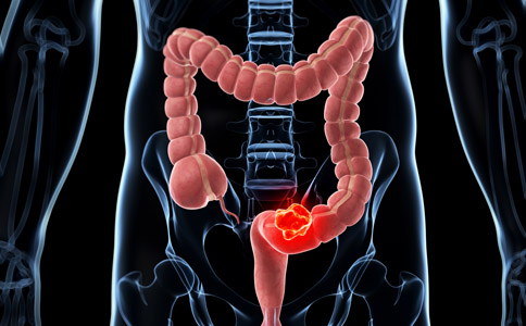 早期结肠癌辅助化疗或可延长患者生存期