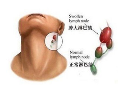 淋巴癌为何悄悄找上你？