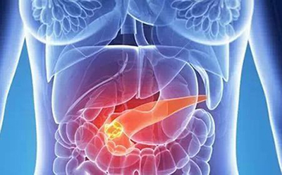 胰腺癌藥物早期試驗資料喜人：總生存率提高10%