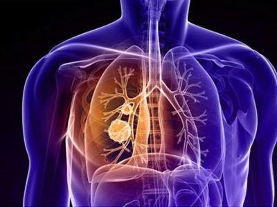 羅氏T藥聯合療法Ⅲ期臨床試驗均到終點，有望一線治療肺癌