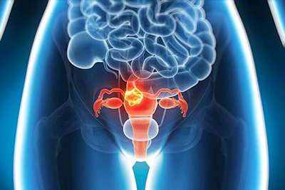 樂伐替尼聯合K藥治療子宮內膜癌，獲美國FDA突破性療法認定